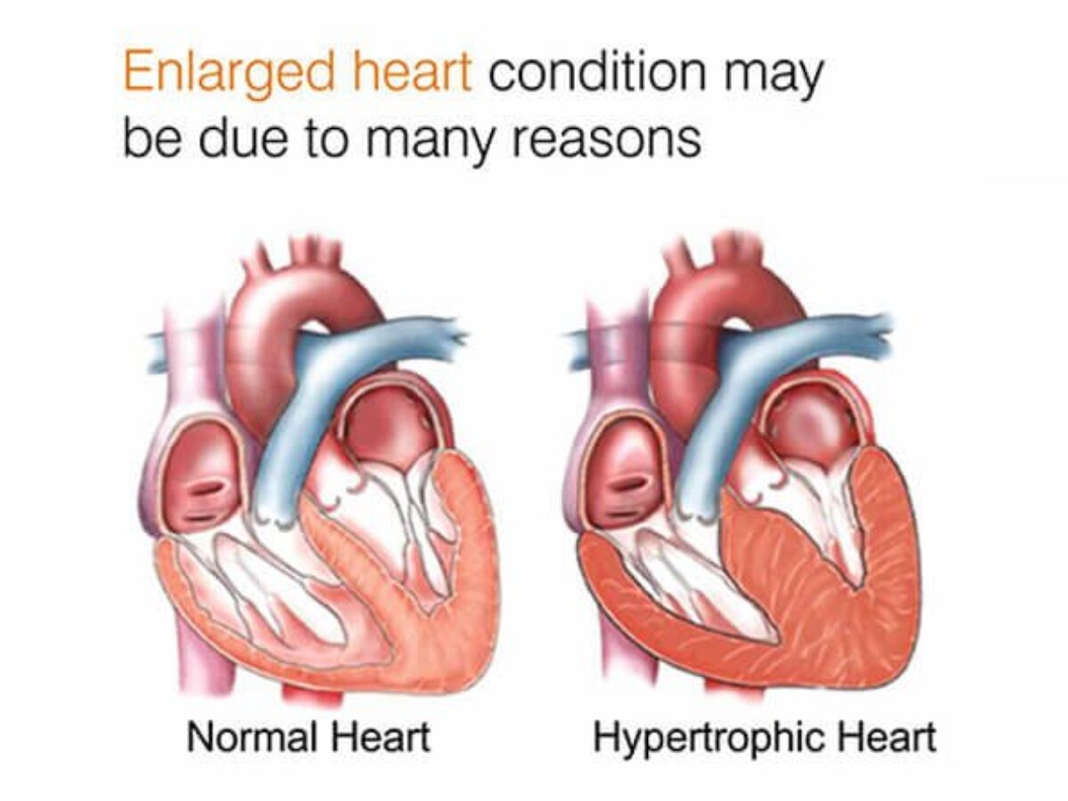 Enlarged heart