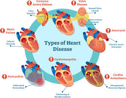 Heart disease